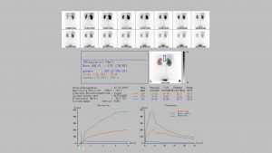 Rostocker Nuklearmedizin Baier - Nierenzintigraphie Rostocker Nuklearmedizin Baier - Nierenzintigraphie