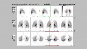 Rostocker Nuklearmedizin Baier - Ventilation-Lungenzintigraphie