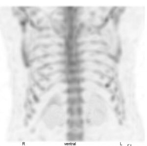 Rostocker Nuklearmedizin Baier - Skelett-Szintigraphie_Ventral